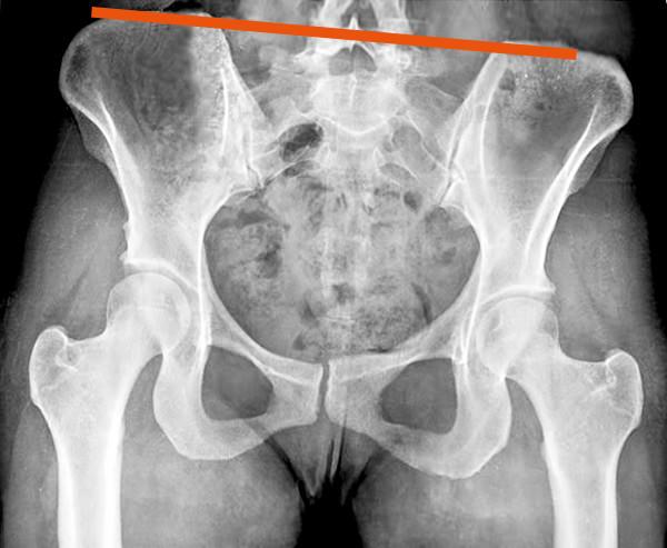 Röntgenaufnahme eines schiefen Beckens Röntgenaufnahme eines schiefen Beckens