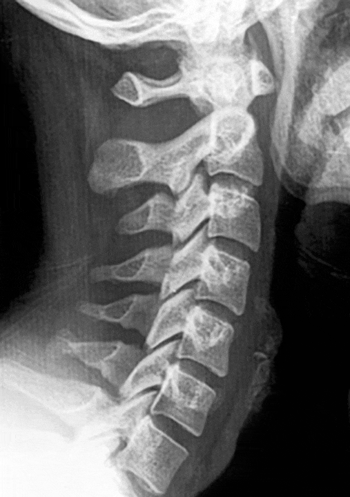 Straightening of the Cervical Lordosis Straightening of the Cervical Lordosis after whiplash