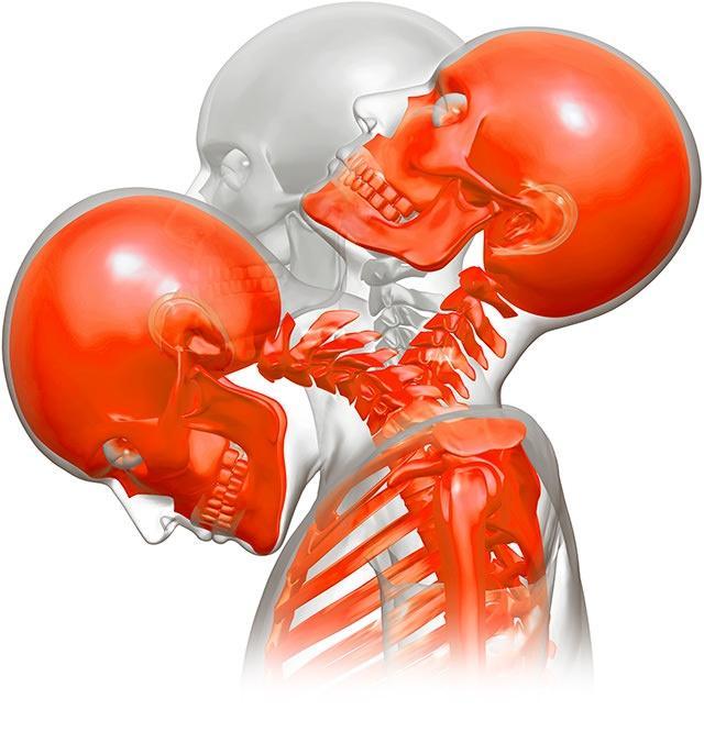 Head movement during whiplash Head movement during whiplash